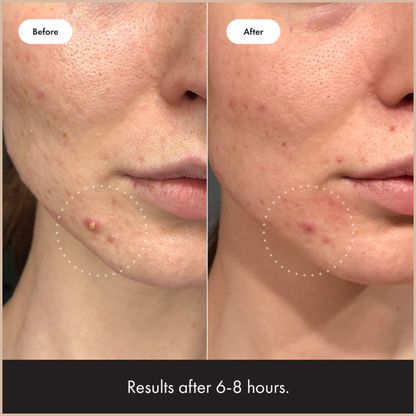 Hero Cosmetics Mighty Patch Invisible+ Daytime Hydrocolloid Acne Pimple Patches