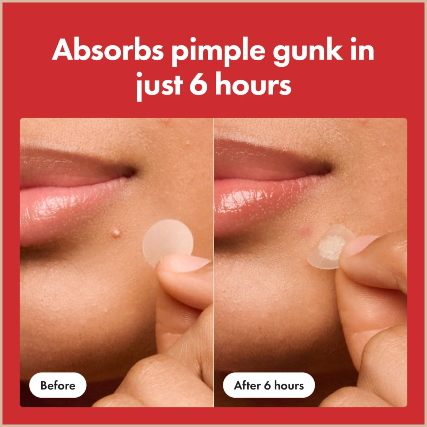 Hero Cosmetics – Mighty Patch Original Acne Pimple Patches