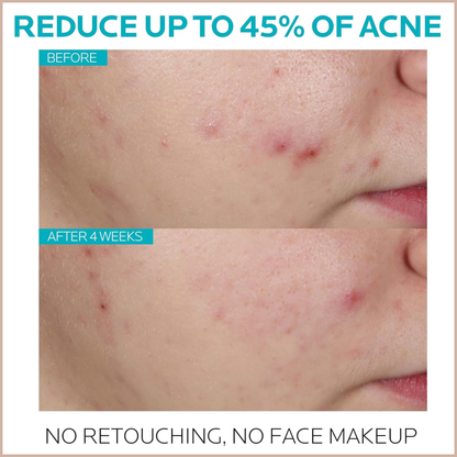 Effaclar 1.5% Salicylic Acid Serum – Acne Treatment Face Serum with Glycolic Acid, LHA & Niacinamide for Blackheads, Whiteheads, Pimples & Post-Acne Marks