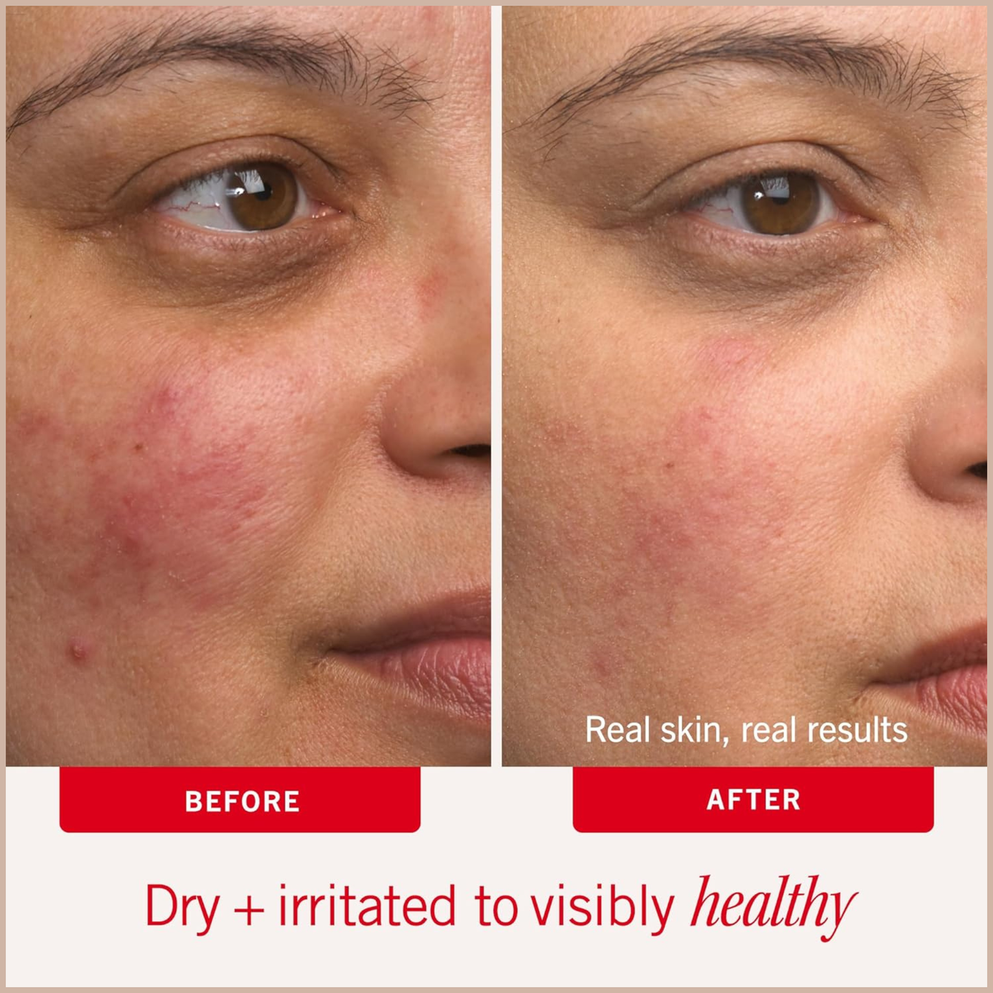 First Aid Beauty Ultra Repair Cream – Intense Hydration Moisturizer