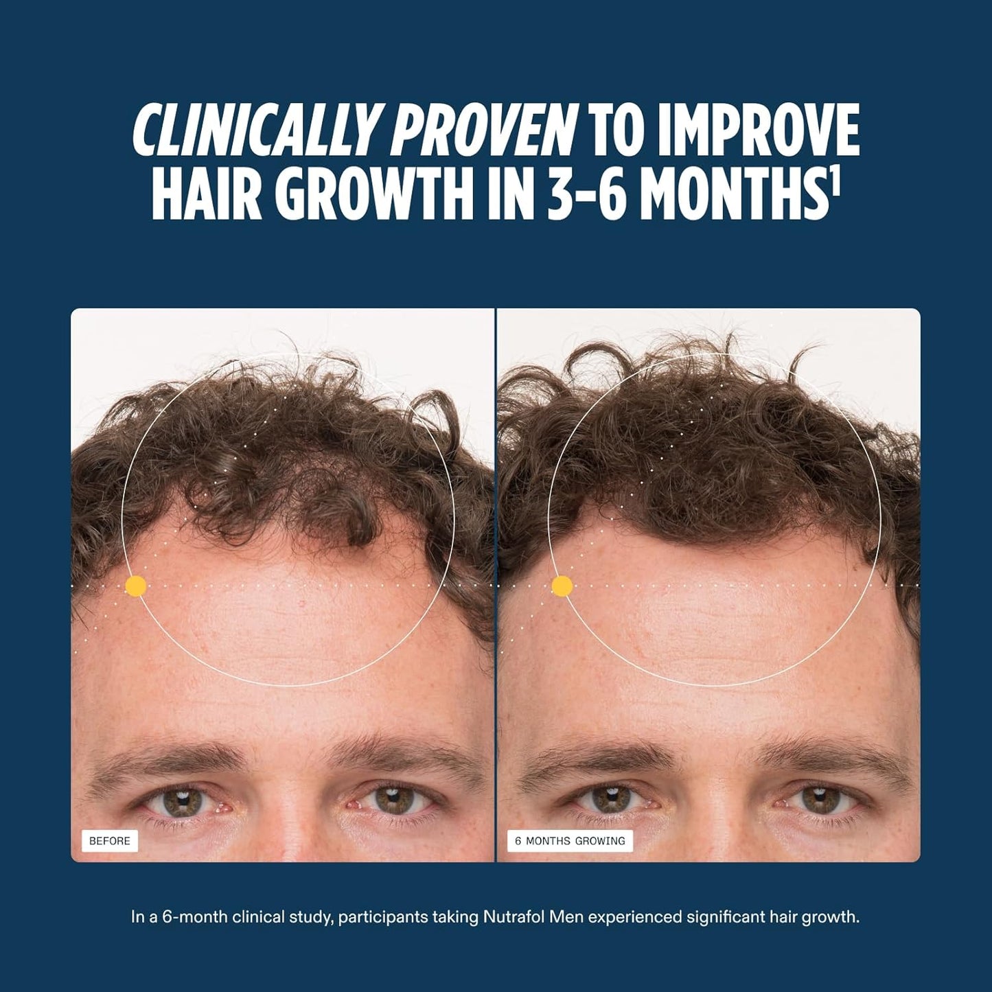 Nutrafol Men’s Hair Growth Supplements – 1-Month Supply for Visibly Thicker Hair & Improved Scalp Coverage