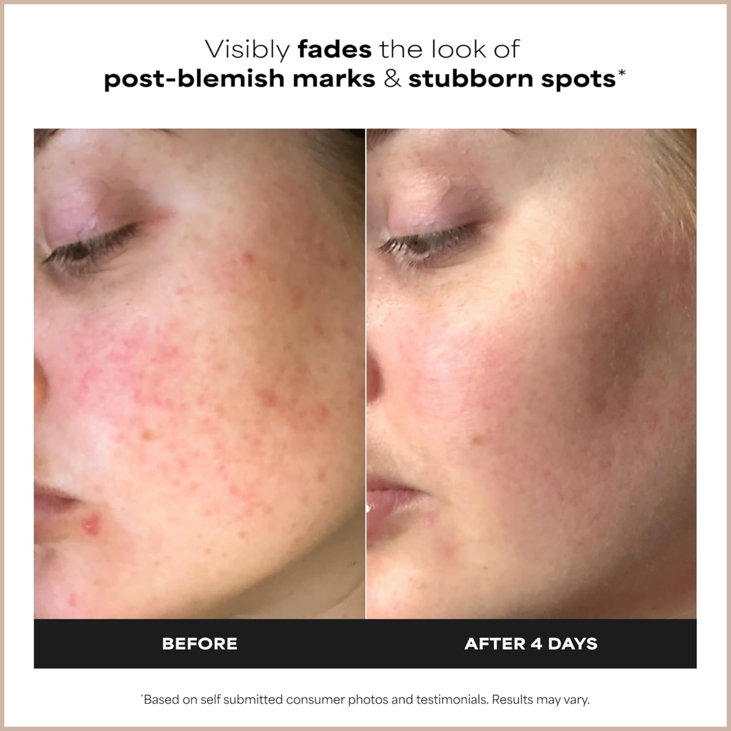 Azelaic Acid Acne Treatment Serum – Clarifying Face Booster for Blemishes & Uneven Skin Tone