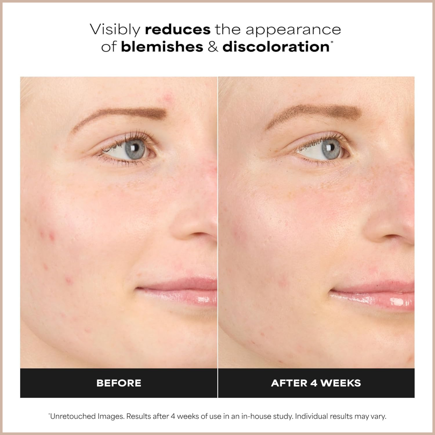 Azelaic Acid Acne Treatment Serum – Clarifying Face Booster for Blemishes & Uneven Skin Tone
