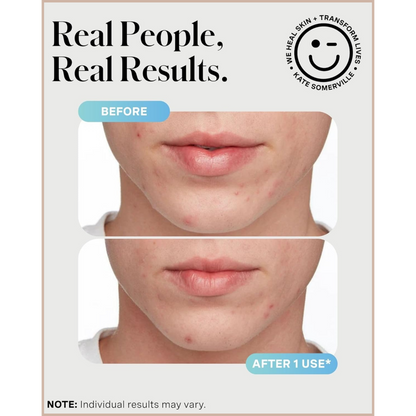 Rapid Acne Spot Treatment with Sulfur & Salicylic Acid for Breakout Reduction